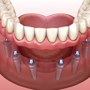 digital illustration of an implant denture