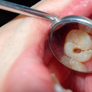 Tooth damaged by decay